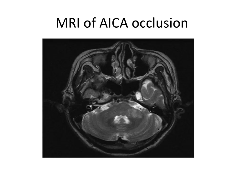 mri of aica occlusion