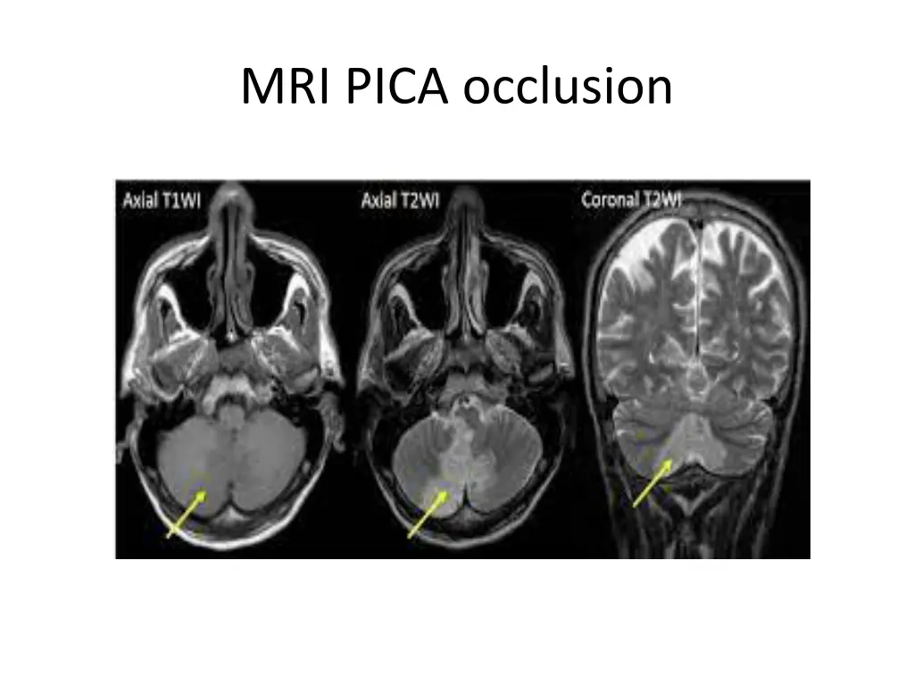mri pica occlusion