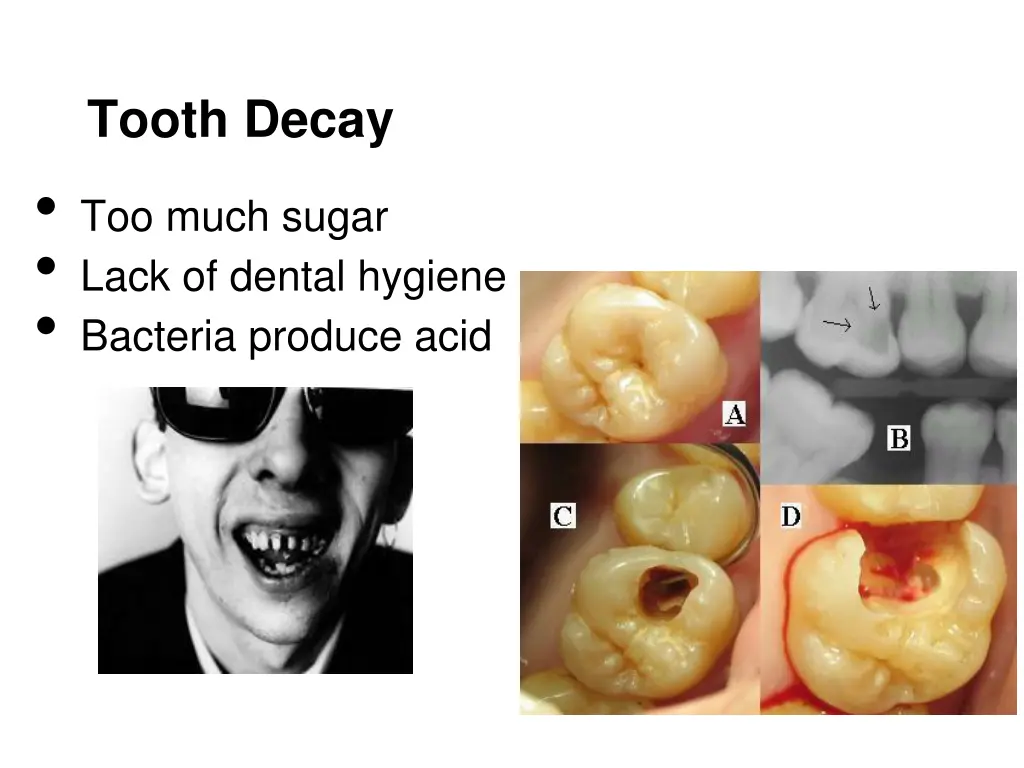 tooth decay too much sugar lack of dental hygiene