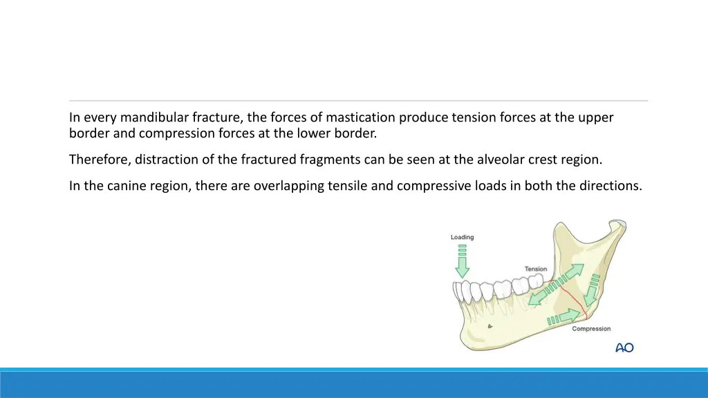 in every mandibular fracture the forces
