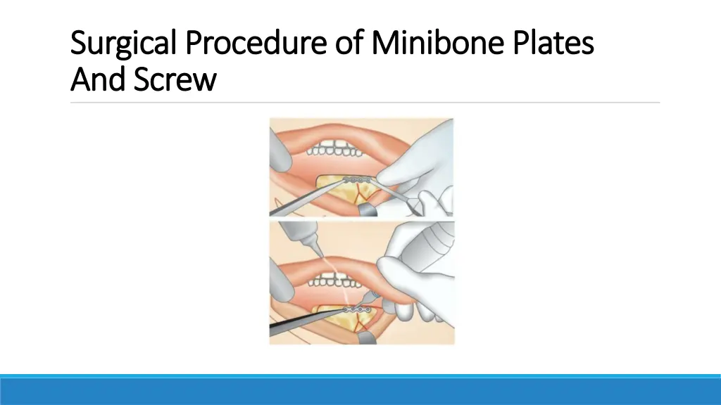 surgical procedure of surgical procedure