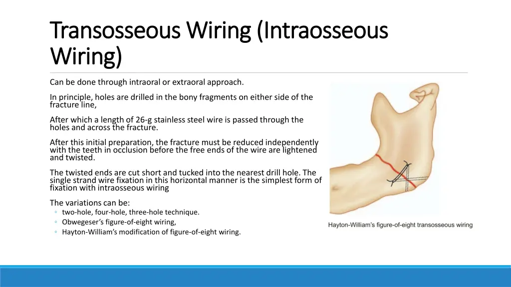 transosseous transosseouswiring intraosseous