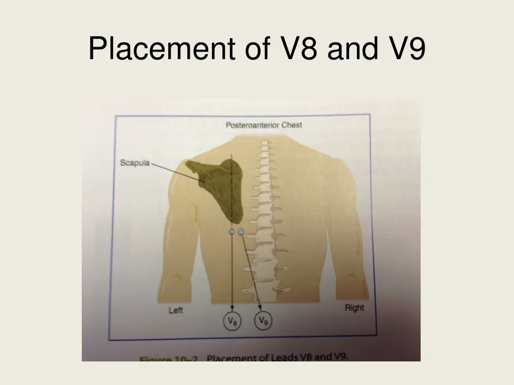 placement of v8 and v9