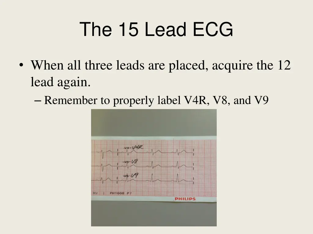 the 15 lead ecg