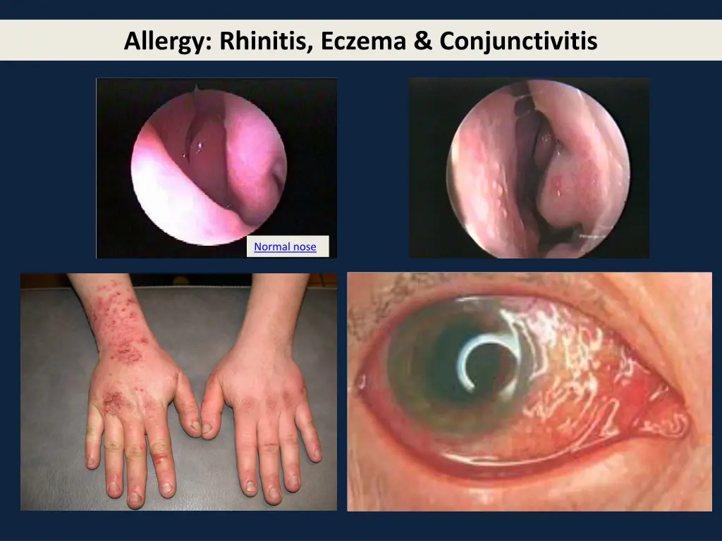 allergy rhinitis eczema conjunctivitis