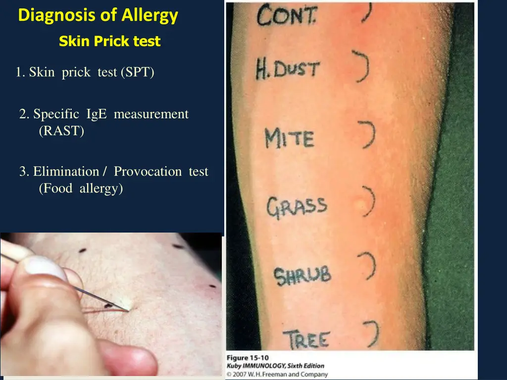 diagnosis of allergy