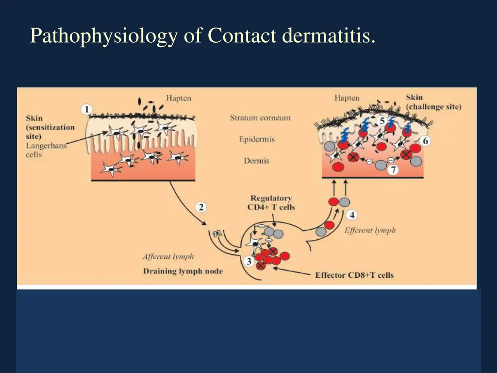 pathophysiology of contact dermatitis
