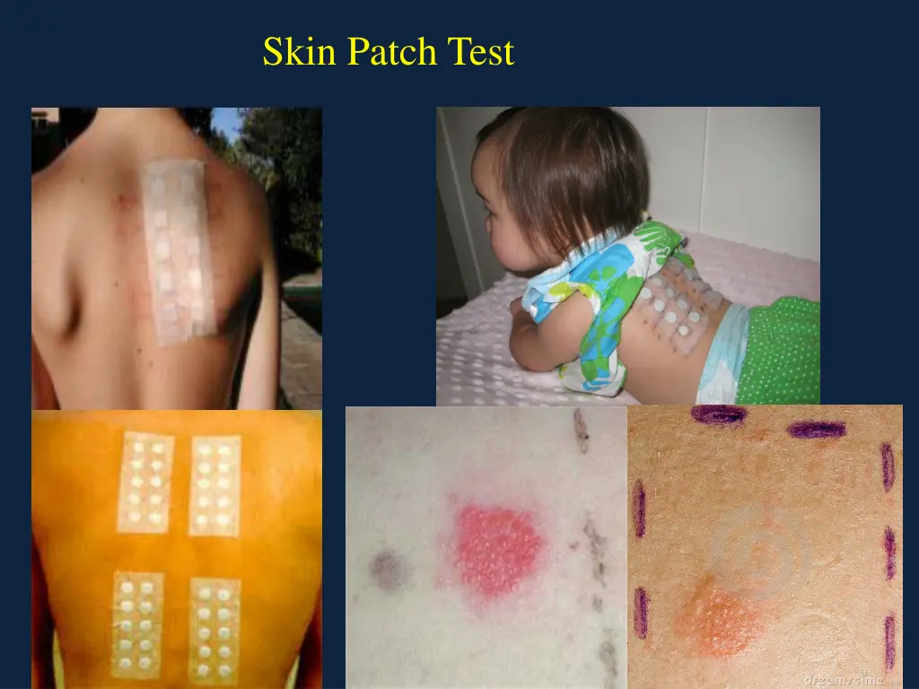 skin patch test
