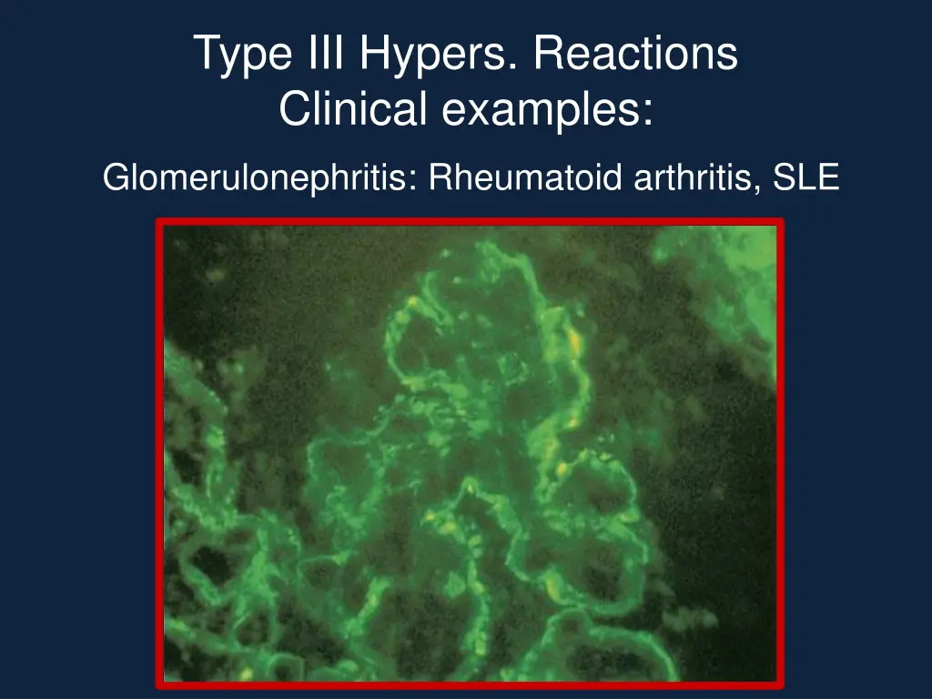 type iii hypers reactions clinical examples