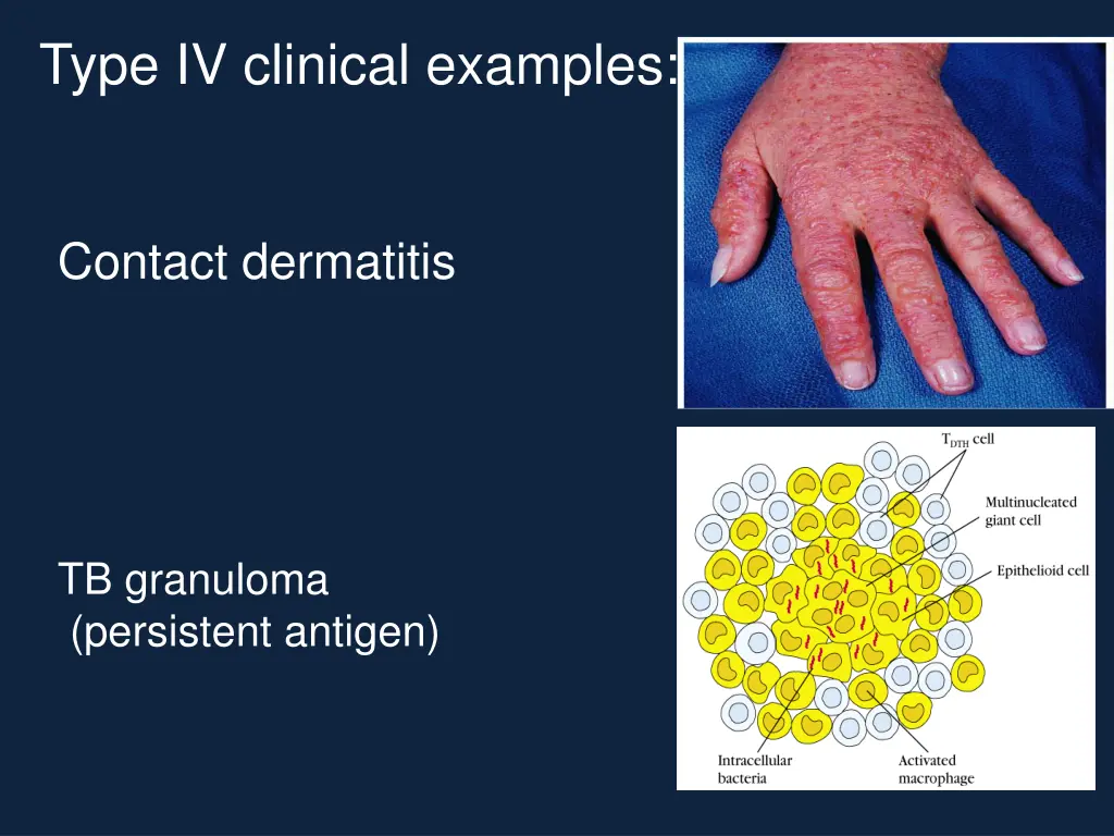 type iv clinical examples