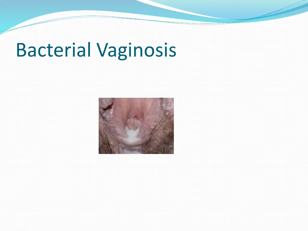 bacterial vaginosis