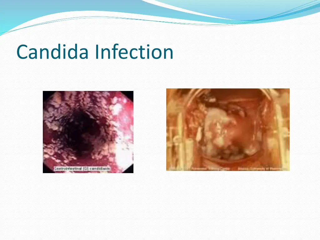 candida infection