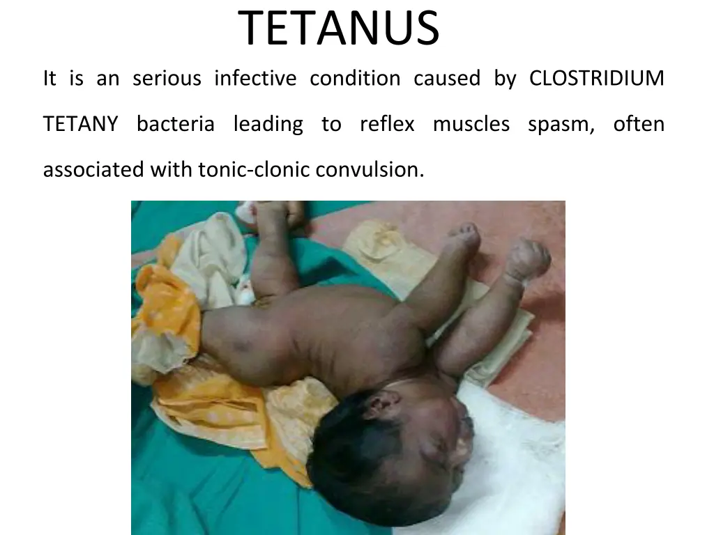 tetanus 1