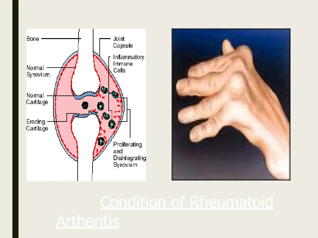 condition of rheumatoid artheritis