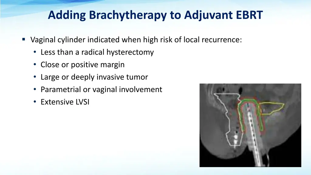 adding brachytherapy to adjuvant ebrt
