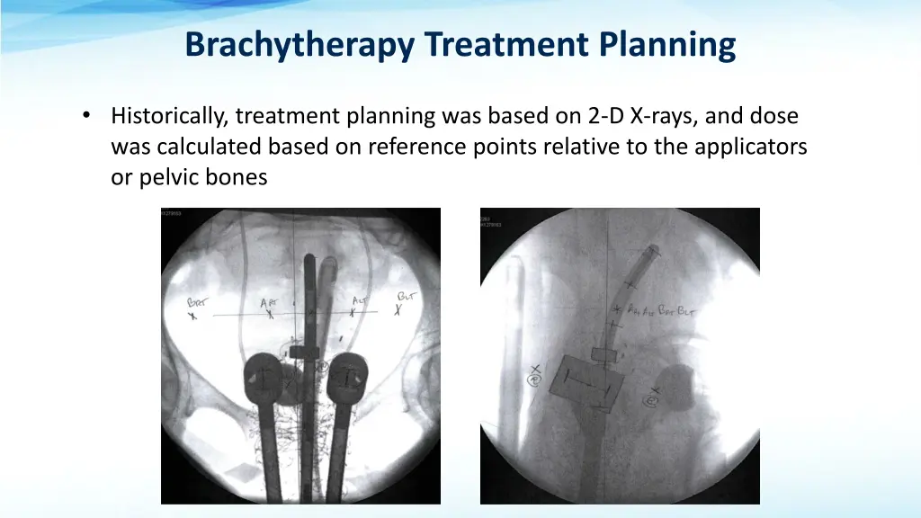 brachytherapy treatment planning 1