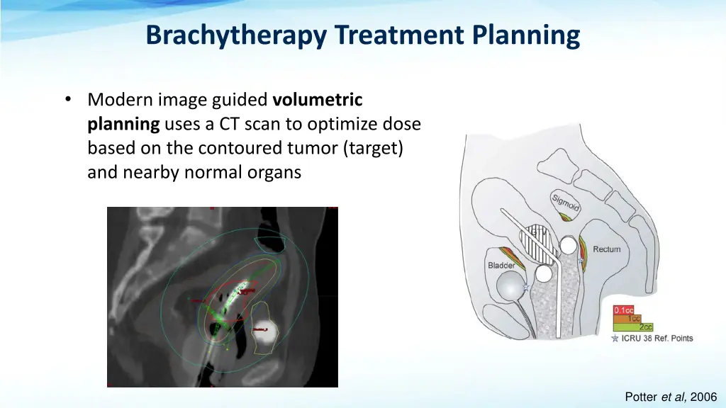 brachytherapy treatment planning