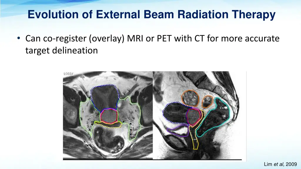 evolution of external beam radiation therapy 1