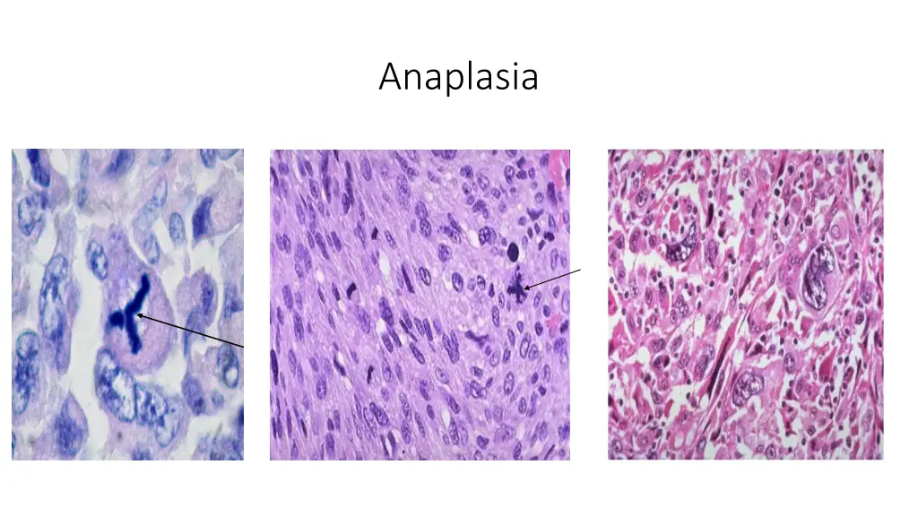 anaplasia