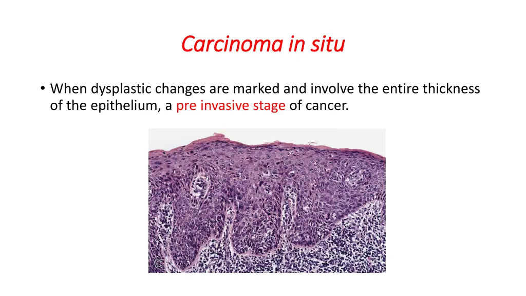 carcinoma in situ carcinoma in situ