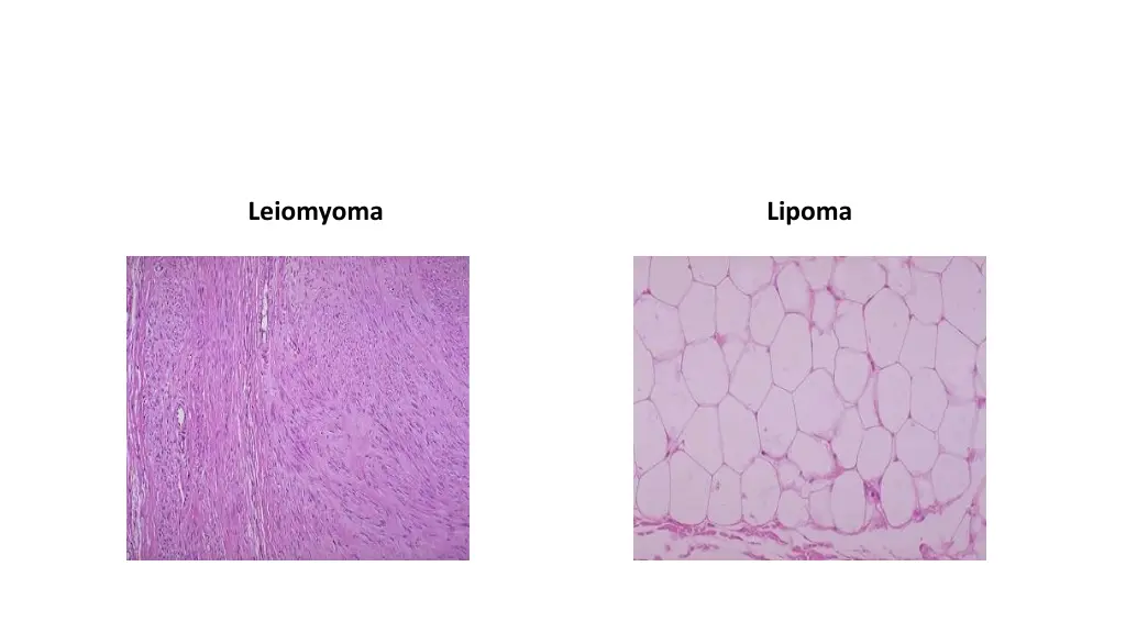 leiomyoma