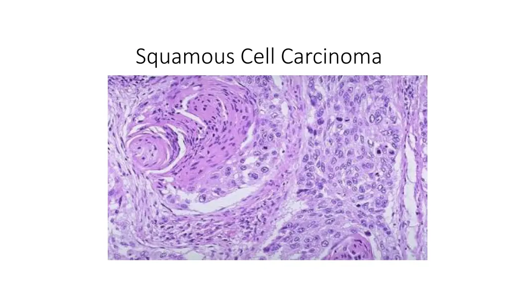 squamous cell carcinoma