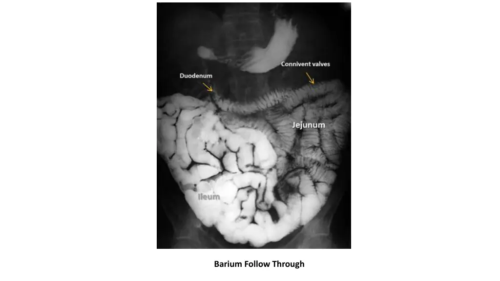 barium follow through 1