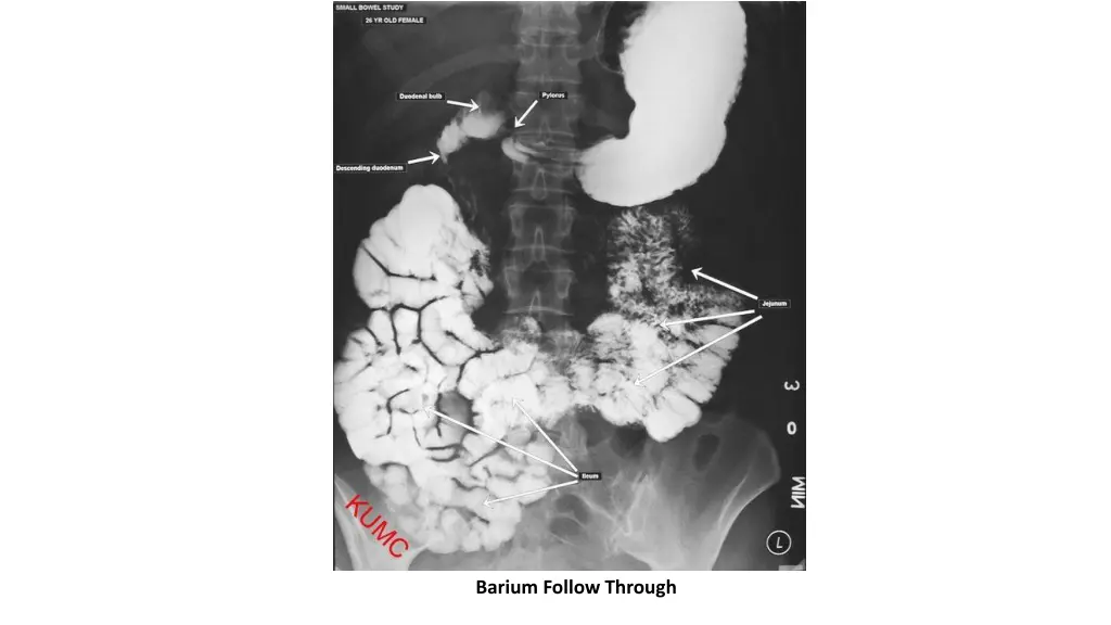 barium follow through 2