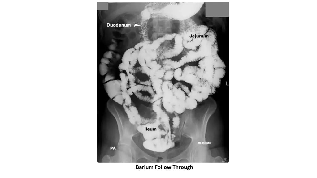 barium follow through 3