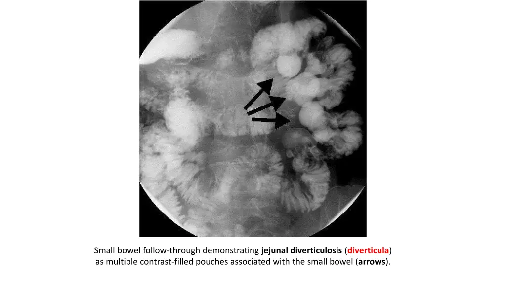 small bowel follow through demonstrating jejunal