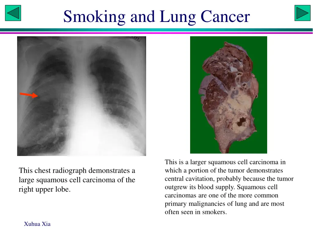 smoking and lung cancer