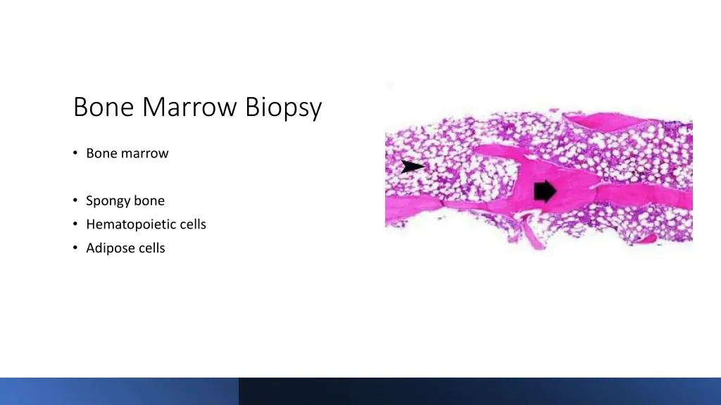 bone marrow biopsy