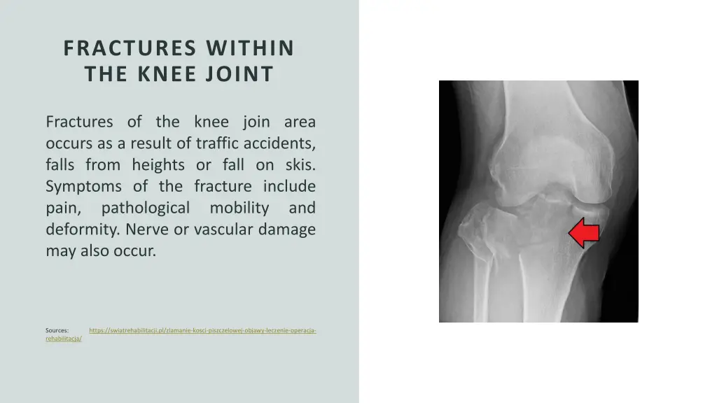 fractures within the knee joint