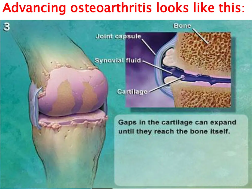 advancing osteoarthritis looks like this