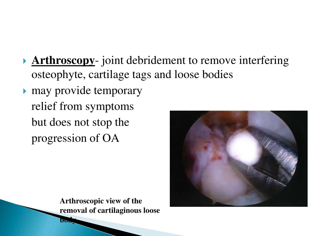 arthroscopy joint debridement to remove