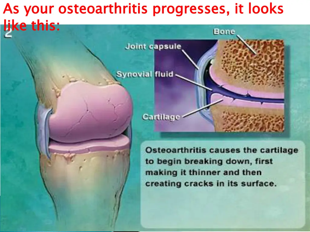 as your osteoarthritis progresses it looks like