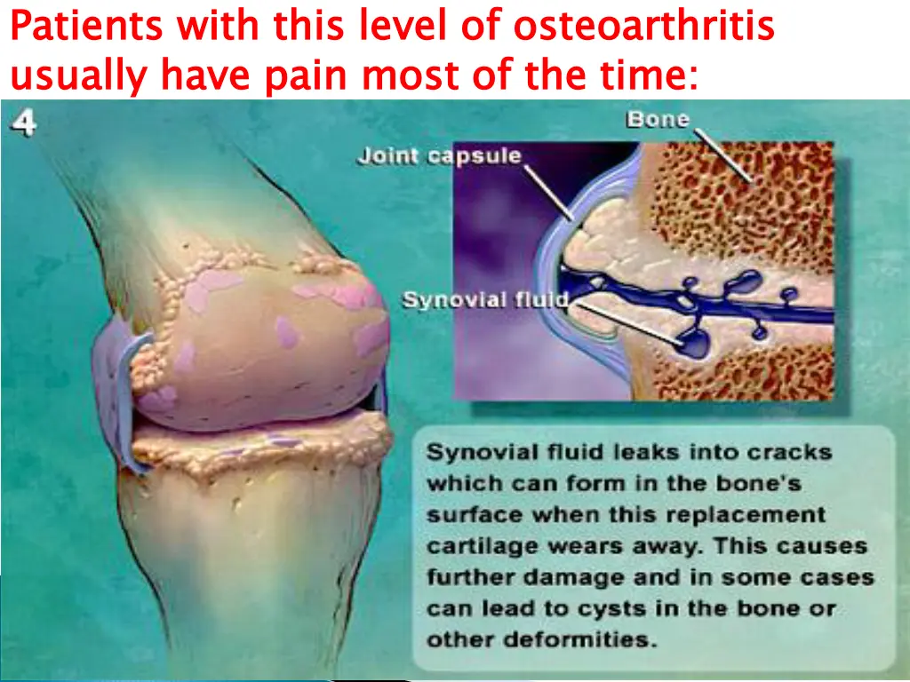 patients with this level of osteoarthritis