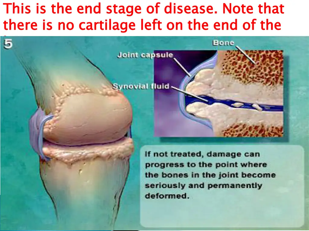 this is the end stage of disease note that there