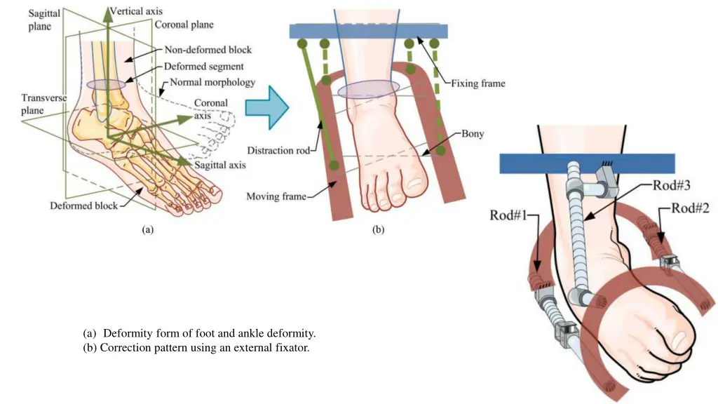 a deformity form of foot and ankle deformity