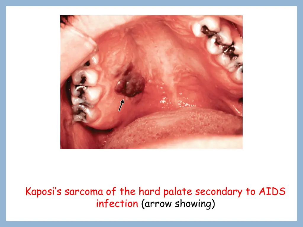 kaposi s sarcoma of the hard palate secondary