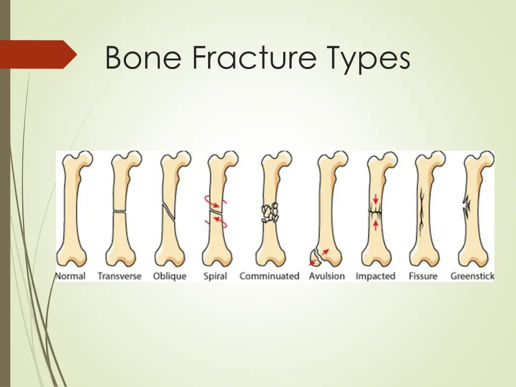 bone fracture types