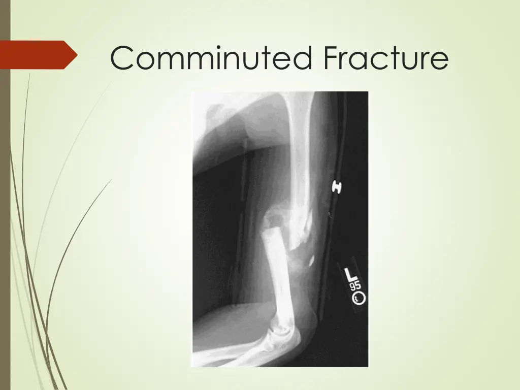 comminuted fracture
