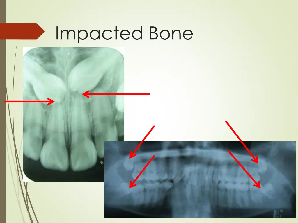impacted bone