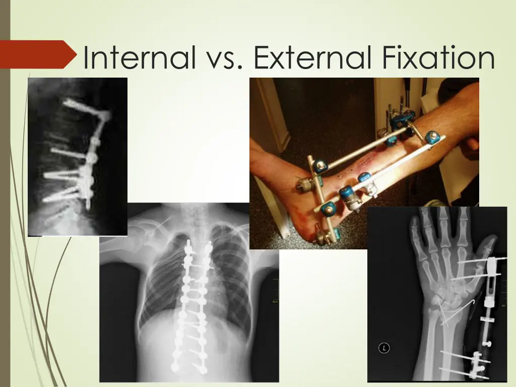 internal vs external fixation