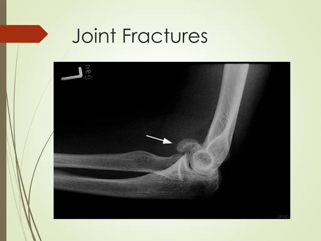 joint fractures