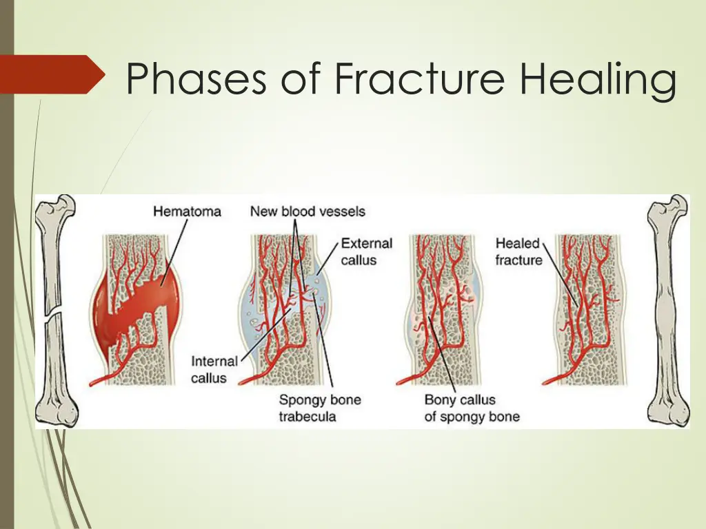 phases of fracture healing