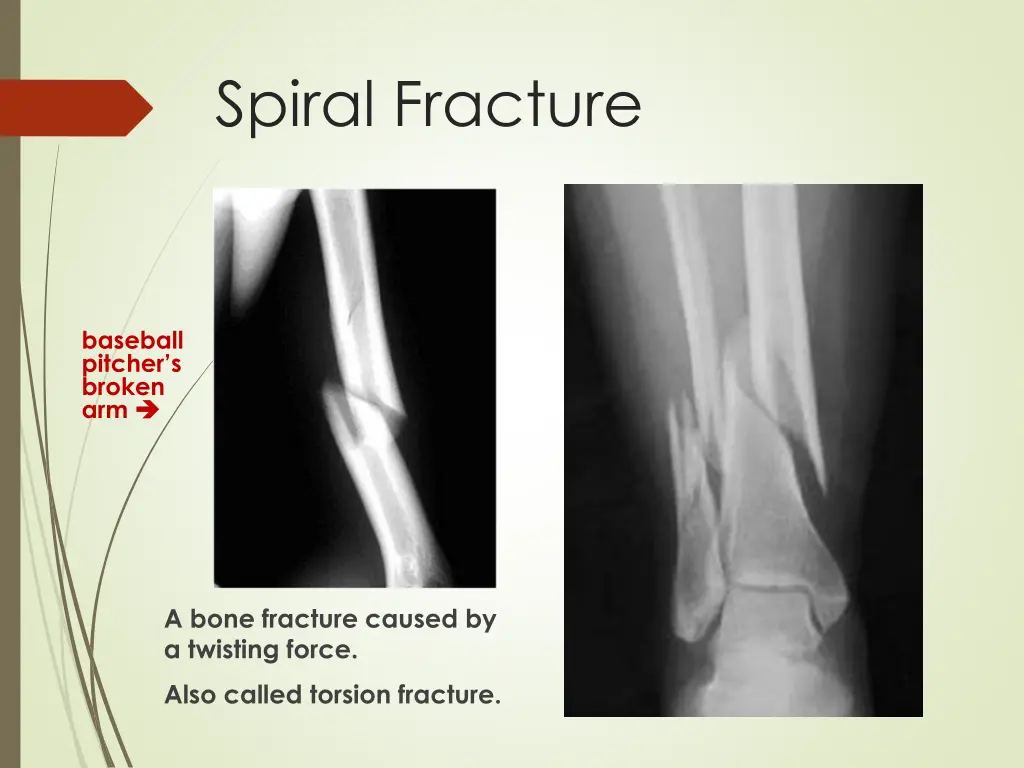spiral fracture