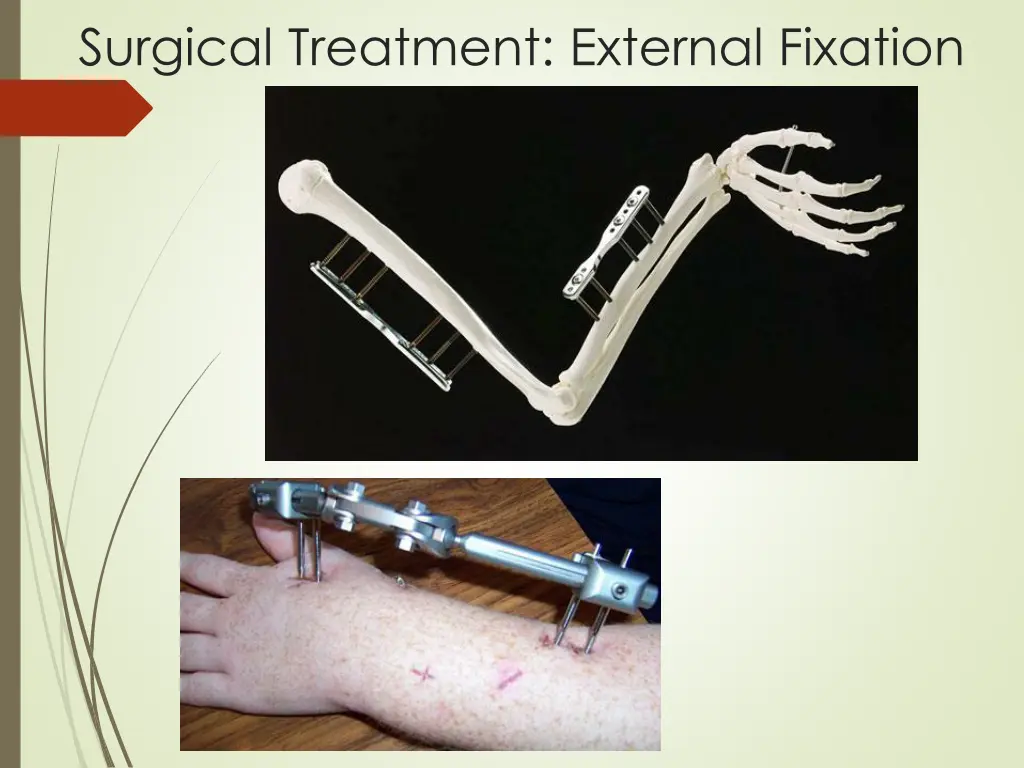 surgical treatment external fixation