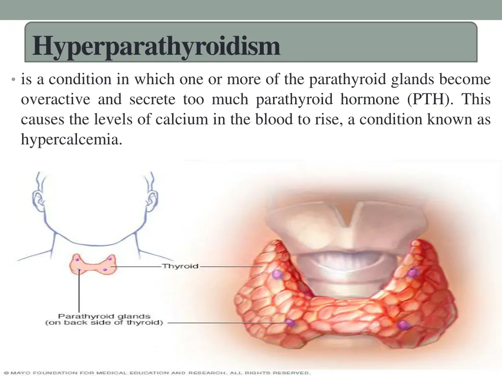 hyperparathyroidism 1