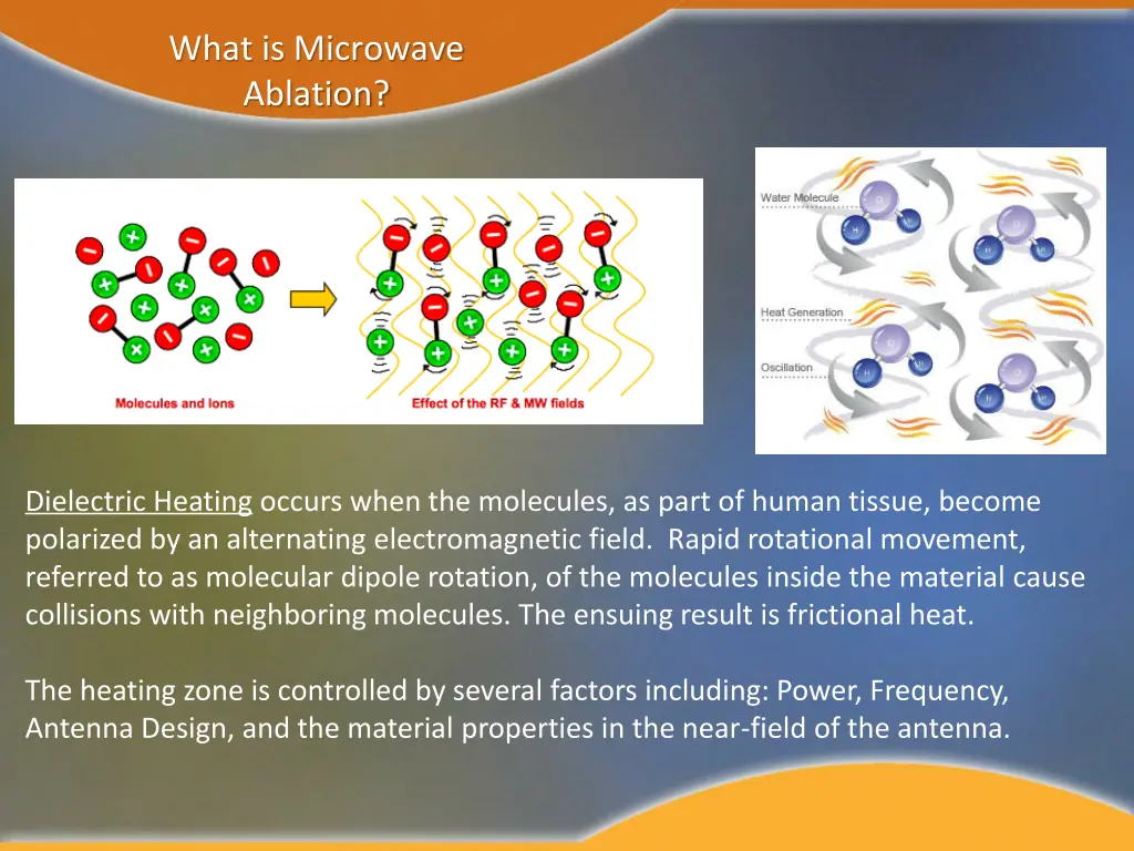 what is microwave ablation 1